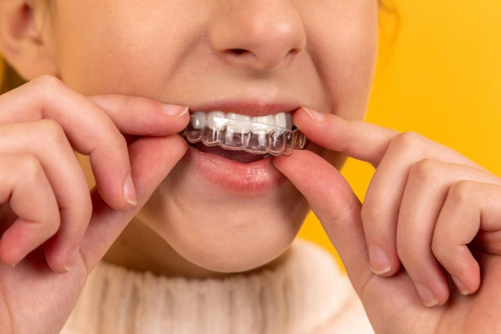 aligners in al ain
