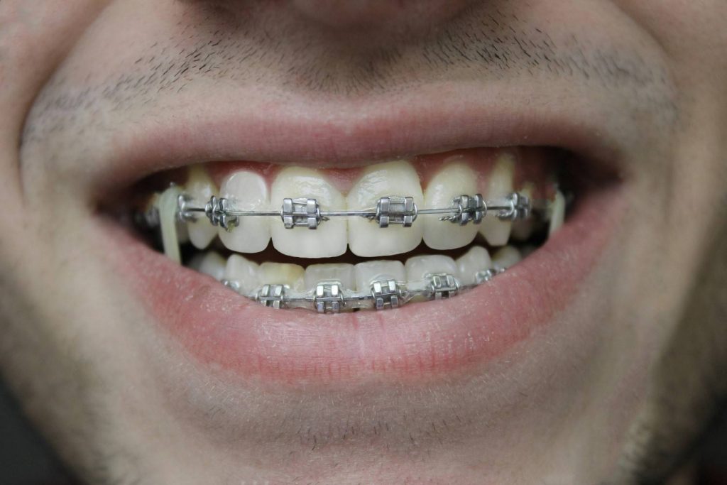 braces in al ain
