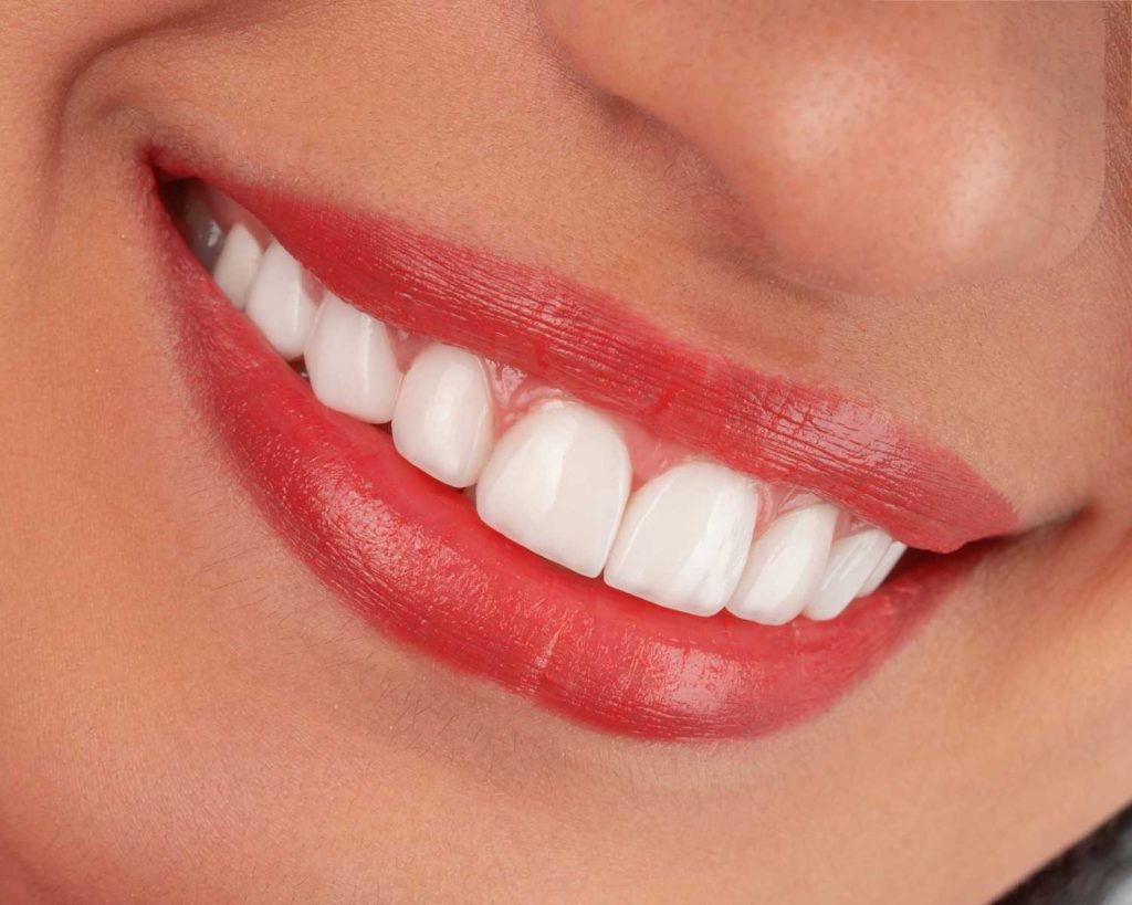 hollywood smile in al ain