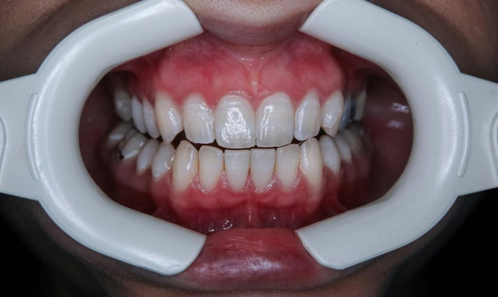 teeth whitening in al ain