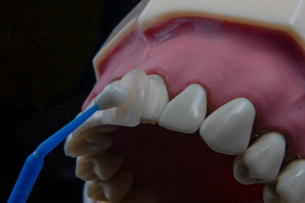 veneers in al ain